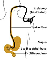 schematische Darstellung einer Gastroskopie